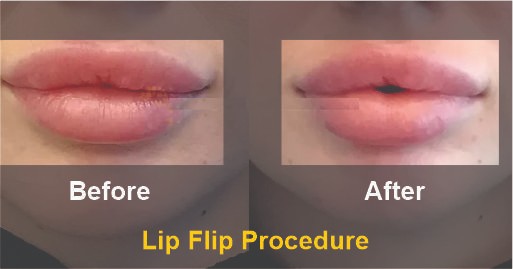 What is the Lip flip Before and After the Procedure Like